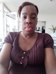 Smiling despite the flares